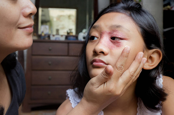 Zuidoost-Aziatische etniciteit tienermeisje met ronde vorm huiduitslag op haar gezicht, wordt toegepast Antifungale crème voor medicatie door haar moeder. Tinea Corporis dermatitis huidprobleem - Foto, afbeelding
