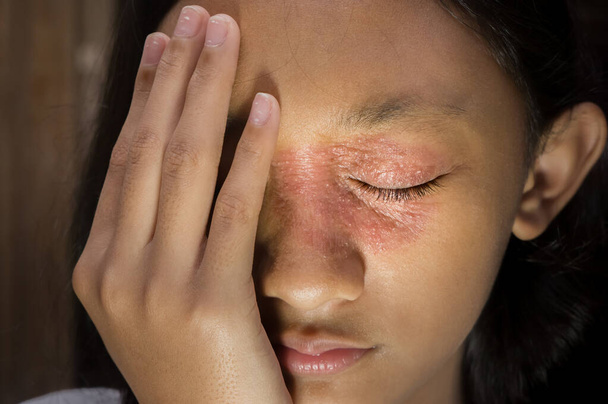 Sudeste Asiático etnia adolescente com forma circular erupção cutânea seca em seu rosto ao redor do olho e nariz, Tinea Corporis dermatite problema de pele
 - Foto, Imagem