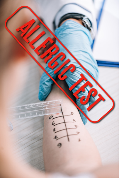 アレルギー検査イラストの女性の手の近くに支配者を保持するアレルゲンのクロップドビュー - 写真・画像