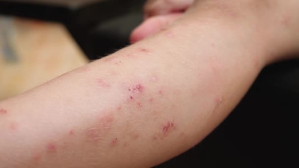 Desinfección de la herida en la piel de la pierna de los niños
 - Metraje, vídeo