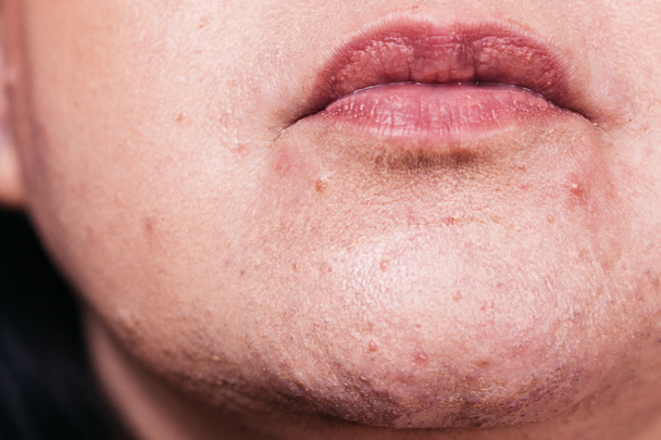 Mature woman showing her face with acne and moles. Adult female no make up with red spots on her chin. Health problem, skin diseases. - Photo, Image