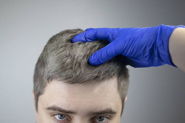A trichologist examines a young mans gray hair under a magnifying glass. Earlier bleaching of hair and pigment as a sign of low melanin in a body - Photo, Image