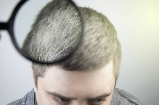 Un tricólogo examina un pelo gris de un hombre joven bajo una lupa. El blanqueamiento temprano del cabello y el pigmento como un signo de melanina baja en un cuerpo
 - Foto, Imagen