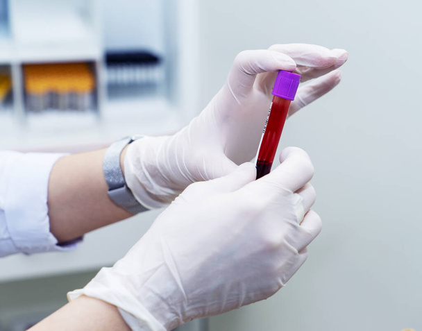 Lekarz w białych gumowych rękawiczkach trzyma probówkę z próbką krwi w laboratorium. Leczenie, koronawirus, pandemia, COVID-19 - Zdjęcie, obraz