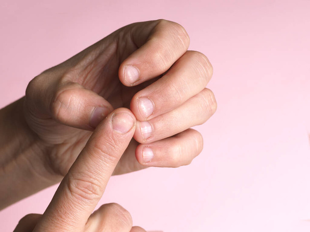 White spots on the nails of the male hand caused by a deficiency of calcium, zinc or poisoning by household chemicals on a pink background. This disease is called leukonychia. - Foto, Bild