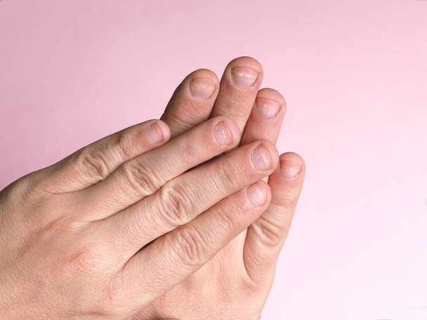 ピンクの背景に家庭用化学物質によるカルシウム、亜鉛または中毒の欠乏によって引き起こされる男性の手の爪の白い斑点。この病気は白血球減少症と呼ばれています. - 写真・画像