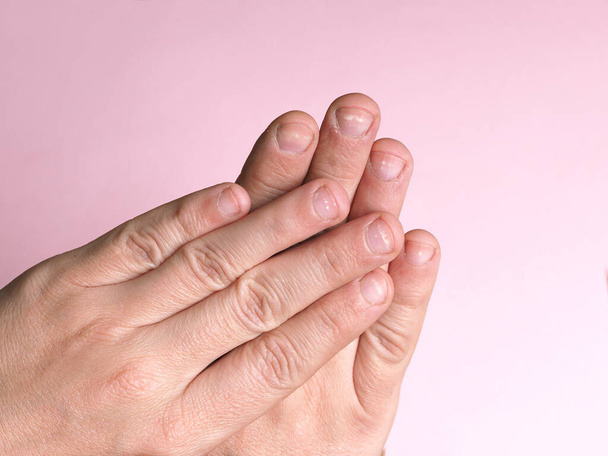 Białe plamy na paznokciach męskiej dłoni spowodowane niedoborem wapnia, cynku lub zatruciem przez chemikalia domowe na różowym tle. Choroba ta nazywa leukonychia. - Zdjęcie, obraz