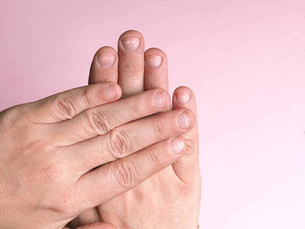 ピンクの背景に家庭用化学物質によるカルシウム、亜鉛または中毒の欠乏によって引き起こされる男性の手の爪の白い斑点。この病気は白血球減少症と呼ばれています. - 写真・画像