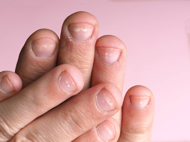 Manchas brancas nas unhas da mão masculina causadas por uma deficiência de cálcio, zinco ou envenenamento por produtos químicos domésticos em um fundo rosa. Esta doença é chamada leuconíquia
. - Foto, Imagem