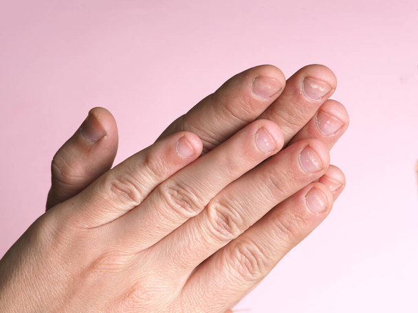 Білі плями на нігтях чоловічої руки, викликані дефіцитом кальцію, цинку або отруєнням побутовими хімічними речовинами на рожевому тлі. Це захворювання називається лейконією
. - Фото, зображення
