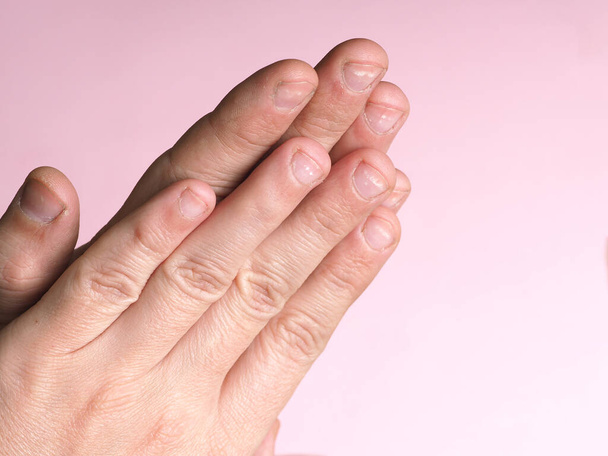 Taches blanches sur les ongles de la main masculine causées par une carence en calcium, zinc ou empoisonnement par des produits chimiques ménagers sur un fond rose. Cette maladie est appelée leukonychie
. - Photo, image