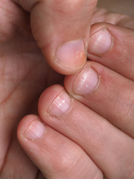 Manchas blancas en las uñas de la mano masculina causadas por una deficiencia de calcio, zinc o envenenamiento por productos químicos domésticos sobre un fondo rosado. Esta enfermedad se llama leuconiquia.
. - Foto, Imagen