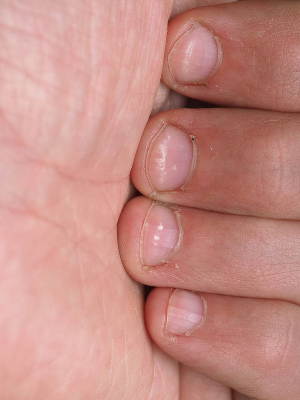 Белые пятна на ногтях мужской руки, вызванные недостатком кальция, цинка или отравления бытовой химией на розовом фоне. Это заболевание называется лейконихией
. - Фото, изображение
