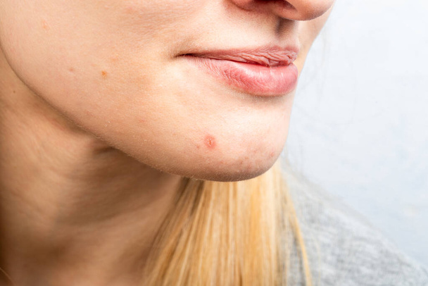 若い女性の皮膚の問題-顎のにきび - 写真・画像