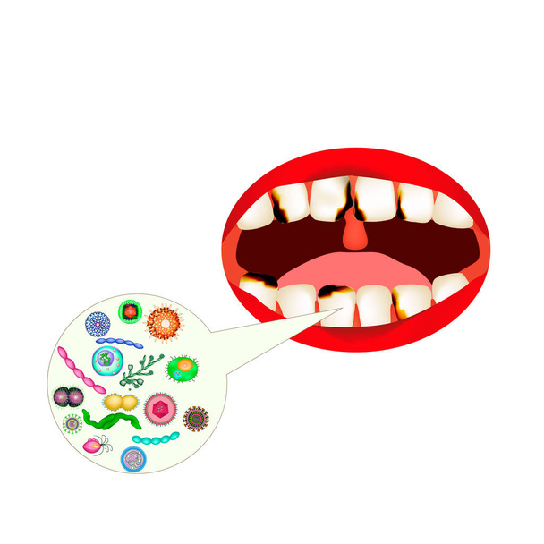 Caries. Ağızdan kokla. Ağız kokusu. Dişlerin yapısı ve ağız boşluğu. Diş hastalıkları taşıyıcıdır. Bilgi grafikleri. İzole edilmiş arkaplanda vektör illüstrasyonu. - Vektör, Görsel