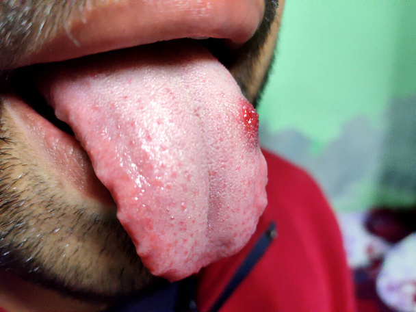 Un primer plano de una lengua enferma en la que una mancha roja brilla. Quemadura e incomodidad de la lengua
 - Foto, imagen