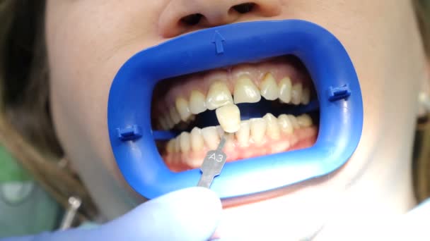 Blanchiment professionnel des dents cosmétiques dans un cabinet de dentiste moderne. Patiente dans une clinique dentaire sur chaise. Médecin comparant les couleurs des dents. Placages dentaires. Gros plan. Images de 4 k
 - Séquence, vidéo