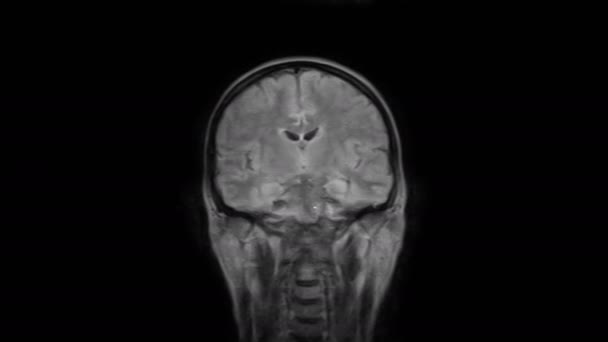 Cerveau IRM purifié, balayages de la tête et détection de tumeurs. Outil médical diagnostique
 - Séquence, vidéo
