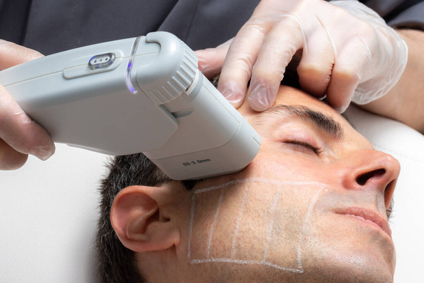 Close up retrato de homem de meia-idade com cosméticos facial de alta intensidade tratamento de ultra-som focal na bochecha
. - Foto, Imagem