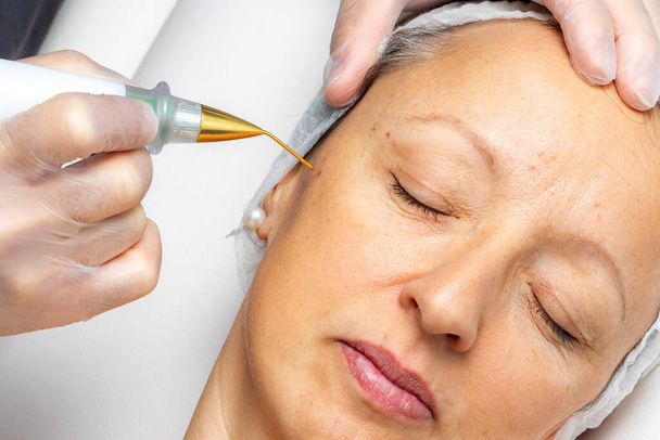 Macro primo piano dettaglio della penna al plasma laser rimozione verruca facciale sulla donna di mezza età
. - Foto, immagini