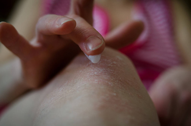 Жінки наносять крем пом'якшувальний на шкіру коліна, як при лікуванні псоріазу крупним планом
 - Фото, зображення