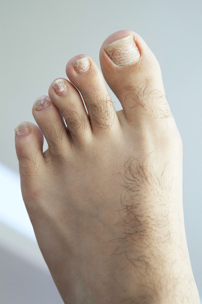 Hongos agrietados uñas de los pies
 - Foto, Imagen