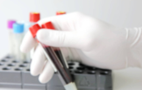 2019-нков - лабораторний тест на підозрілу інфекцію людини. Коронавірус (Covid-19) - інфекційне захворювання, спричинене новим вірусом, який раніше не був ідентифікований у людей.. - Фото, зображення