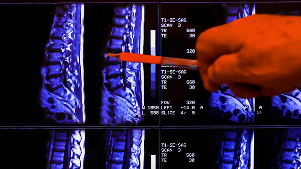Врач анализирует результаты магнитно-резонансной томографии позвоночника пациента с хронической болью в спине. МРТ показывает дегенеративные изменения позвонков, грыжи поясничных дисков и сжатие нервных корешков
. - Фото, изображение