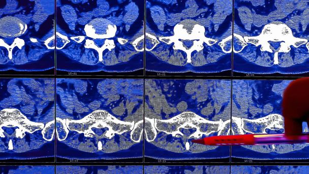 Médecin analyse les résultats de la tomodensitométrie ou l'imagerie CT de la colonne vertébrale humaine d'un patient souffrant de maux de dos chroniques, montre des changements dégénératifs des épines, hernie des disques lombaires et compression des racines nerveuses
 - Photo, image