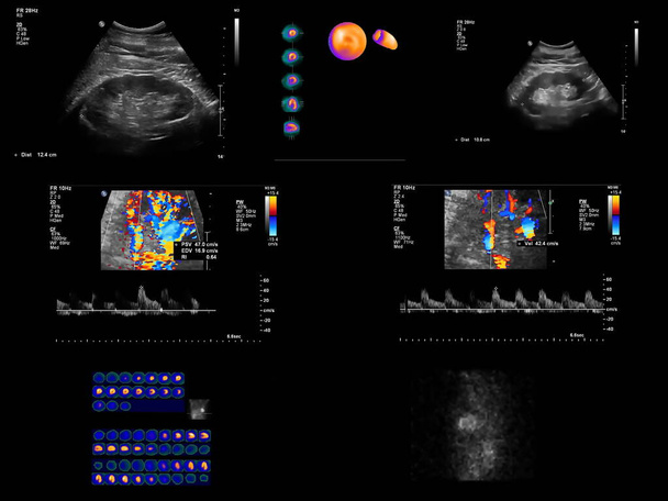 A angiografia por tomografia computadorizada coronária (ATC) utiliza uma injeção de contraste contendo iodo e tomografia computadorizada para examinar as artérias que fornecem sangue ao coração.
 - Foto, Imagem