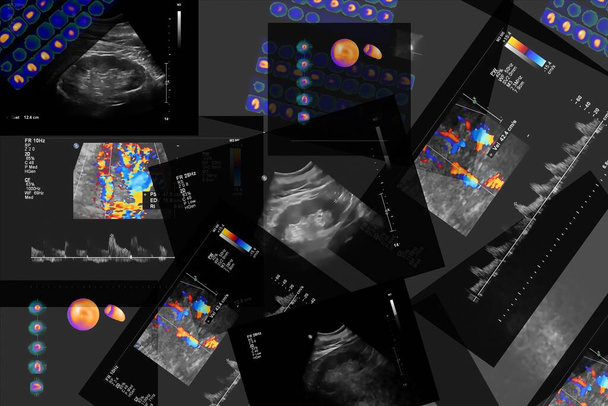 Tomografia coronarica computerizzata angiografia (CCTA) del cuore e dei vasi coronarici utilizzando fluido di contrasto e stress e determinare se sono stati ridotti. Serie di risultati
 - Foto, immagini