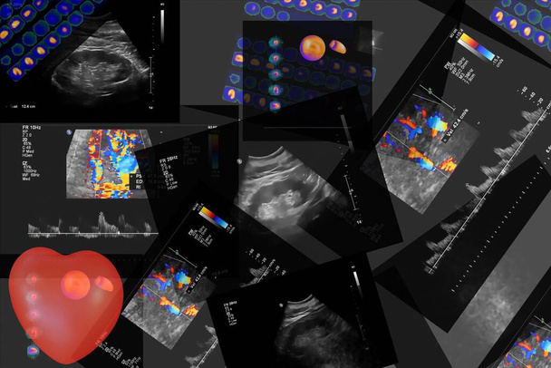Angiografía por tomografía computarizada coronaria (CCTA) del corazón y los vasos coronarios utilizando líquido de contraste y estrés y determinar si se han estrechado
. - Foto, Imagen