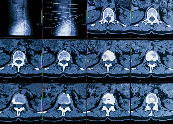 Resultados de la tomografía computarizada o tomografía computarizada de la columna vertebral humana de un paciente con dolor de espalda crónico, muestra cambios degenerativos de las espinas, hernia de los discos lumbares y compresión de las raíces nerviosas
 - Foto, Imagen