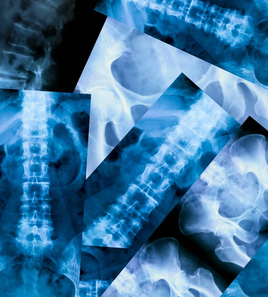 Set of X-ray of the bones of the human lower lumbar part of the vertebral column - Photo, Image