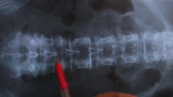 Az orvos tanulmányozza az emberi gerincoszlop csontjainak röntgenfelvételét, 4k - Felvétel, videó
