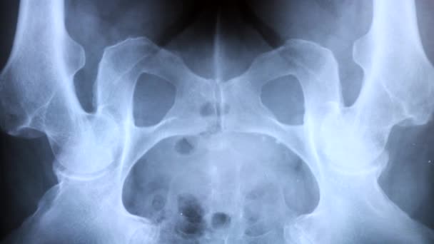 Doktor studující rentgen pánevních kostí, 4k - Záběry, video