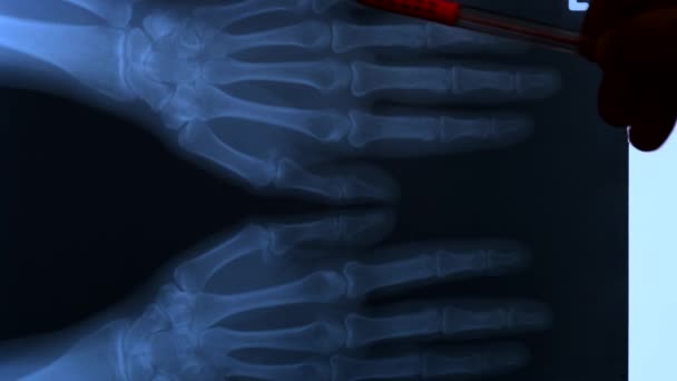 Doctor estudiando placa de rayos X de los huesos de las dos manos humanas, 4K
 - Metraje, vídeo