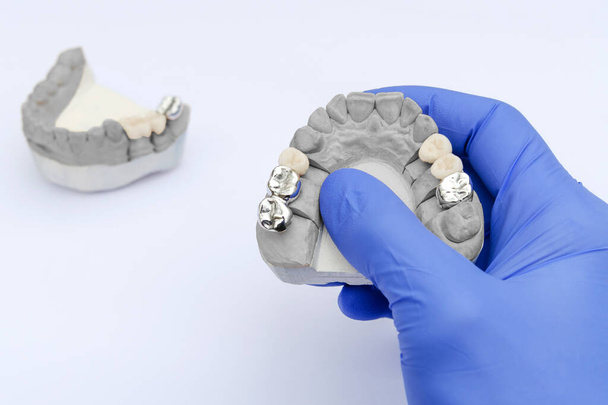 valse tanden. metalen en keramische kronen en bruggen. De hand van de tandarts houdt een gips model vast. concept van orthopedische tandheelkunde - Foto, afbeelding