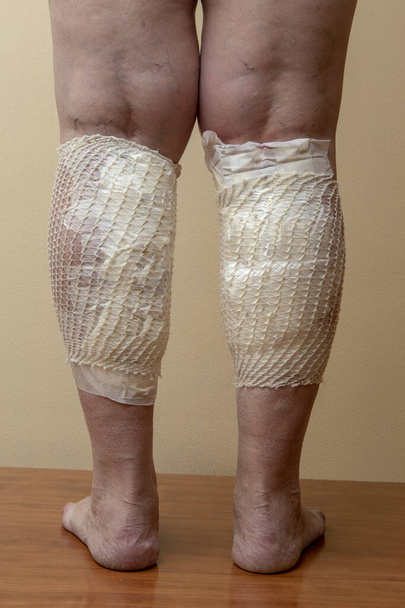 Zabandażowane nogi żylaków po leczeniu pijawkami. Leczenie żylaków hirudoterapią. - Zdjęcie, obraz