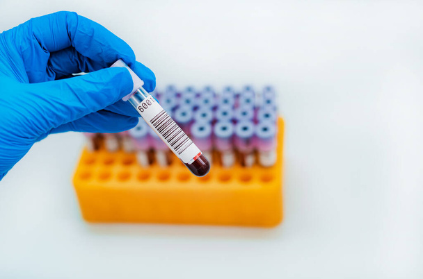 ピペットと血液サンプルチューブと他のサンプルとのスタンドを持つ研究室のアシスタントは、検査のための血液検査管を保持しています。ウイルスの血液検査、コロナウイルス - 写真・画像