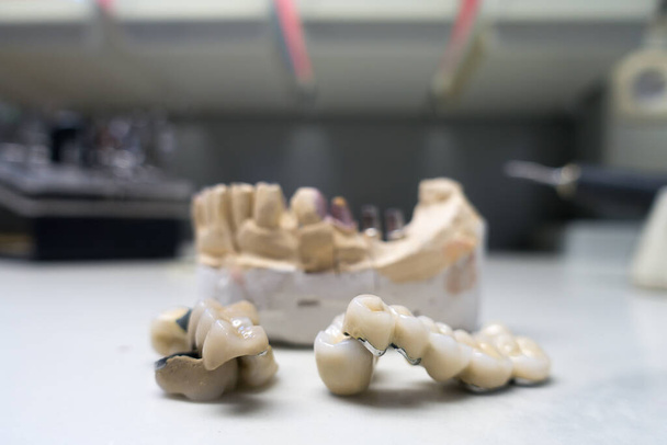 modèle de gypse de la mâchoire humaine avec implants dentaires - Photo, image