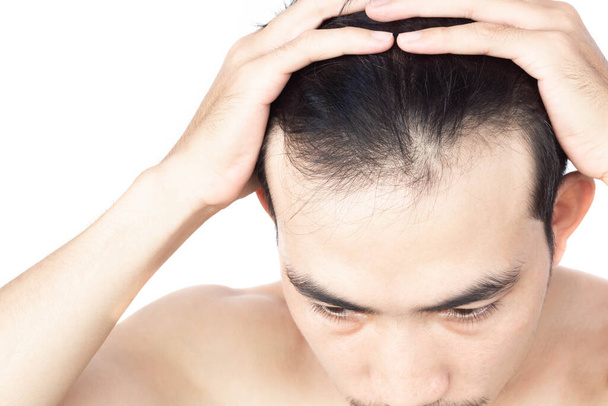 Jeune homme grave problème de perte de cheveux pour les soins de santé médical et shampooing concept de produit, accent sélectif - Photo, image