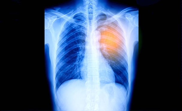 Imagem de raio-X do tórax humano para um diagnóstico médico
 - Foto, Imagem