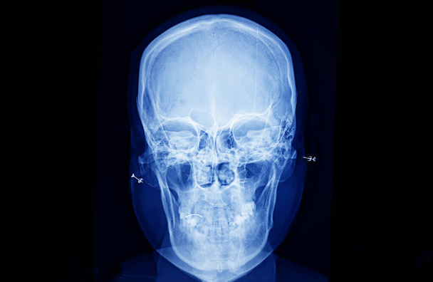 フィルム x 線頭蓋骨と頸椎側面図 - 写真・画像