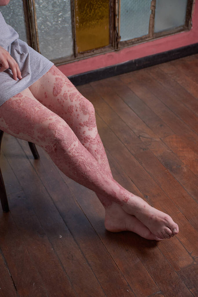 Zicht op been en voeten van vrouw met psoriasis - Foto, afbeelding