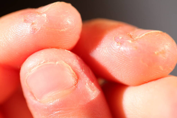 Onychophagia. gebeten nagels in een kind. - Foto, afbeelding