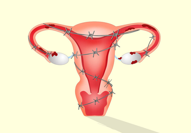 endometriózis ábrázolása szögesdróttal - Fotó, kép
