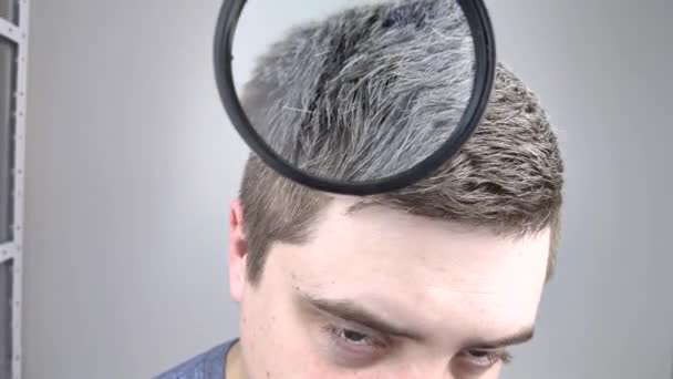Een trioloog onderzoekt een jonge man grijs haar onder een vergrootglas. Eerder bleken van haar en pigment als teken van een lage melanine in een mannelijk lichaam - Video
