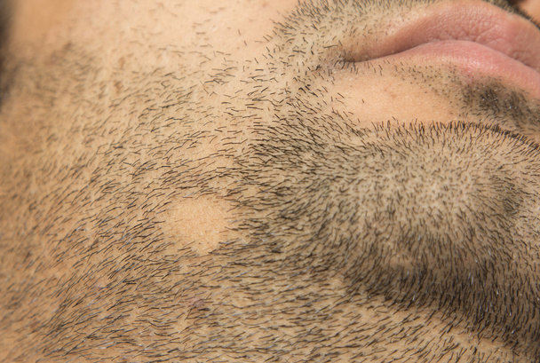Alopecia areata Haarausfall am Wangenbart in einem Patch - Foto, Bild