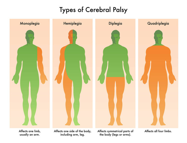  types of cerebral palsy vector illustration - Vector, Image